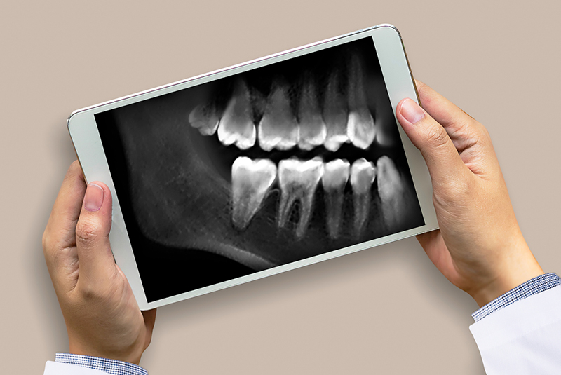 bitewing dental x-ray